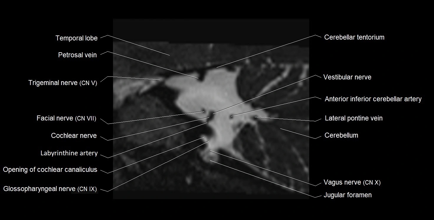 Internal auditory meatus (IAM) 3T sagittal cross sectional anatomy image 28.webp